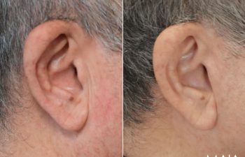 70 year-old male before and 1 year after deep plane facelift, neck lift, temple lift, fat grafting, and nanofat grafting.