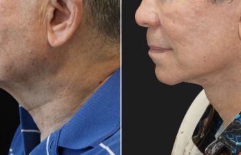 70 year-old male before and 1 year after deep plane facelift, neck lift, temple lift, fat grafting, and nanofat grafting.