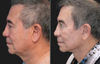 70 year-old male before and 1 year after deep plane facelift, neck lift, temple lift, fat grafting, and nanofat grafting.