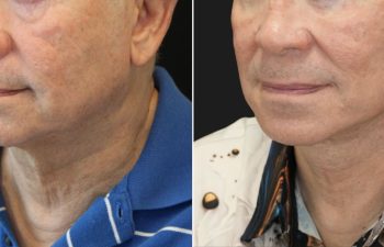 70 year-old male before and 1 year after deep plane facelift, neck lift, temple lift, fat grafting, and nanofat grafting.