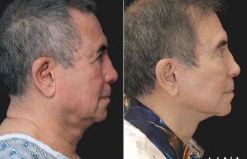 70 year-old male before and 1 year after deep plane facelift, neck lift, temple lift, fat grafting, and nanofat grafting.