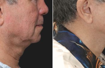 70 year-old male before and 1 year after deep plane facelift, neck lift, temple lift, fat grafting, and nanofat grafting.