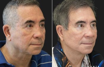 70 year-old male before and 1 year after deep plane facelift, neck lift, temple lift, fat grafting, and nanofat grafting.