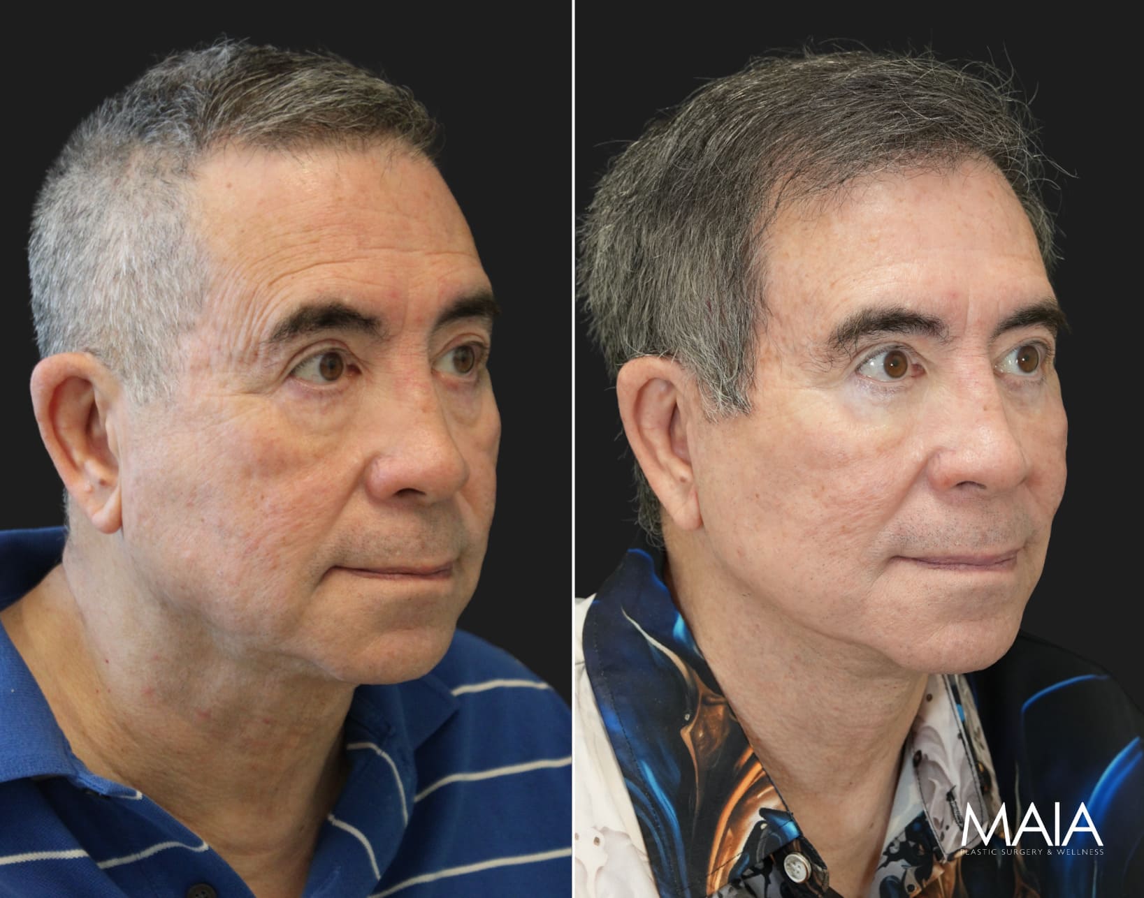 70 year-old male before and 1 year after deep plane facelift, neck lift, temple lift, fat grafting, and nanofat grafting.