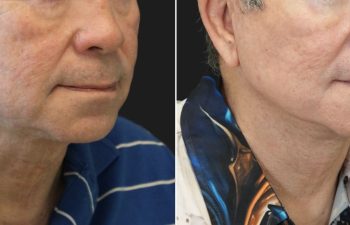 70 year-old male before and 1 year after deep plane facelift, neck lift, temple lift, fat grafting, and nanofat grafting.