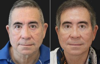 70 year-old male before and 1 year after deep plane facelift, neck lift, temple lift, fat grafting, and nanofat grafting.
