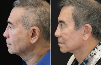 70 year-old male before and 1 year after deep plane facelift, neck lift, temple lift, fat grafting, and nanofat grafting.