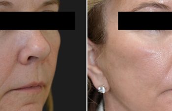 57 year old patient before and 1 session after CO2