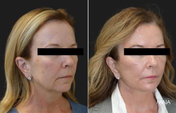 57 year old patient before and 1 session after CO2