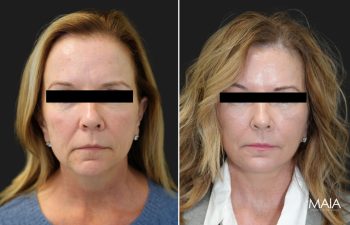 57 year old patient before and 1 session after CO2