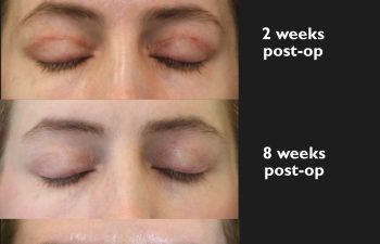Healing progression showing before surgery, 2 weeks post-op, 8 weeks post-op, and 3 months post-op.