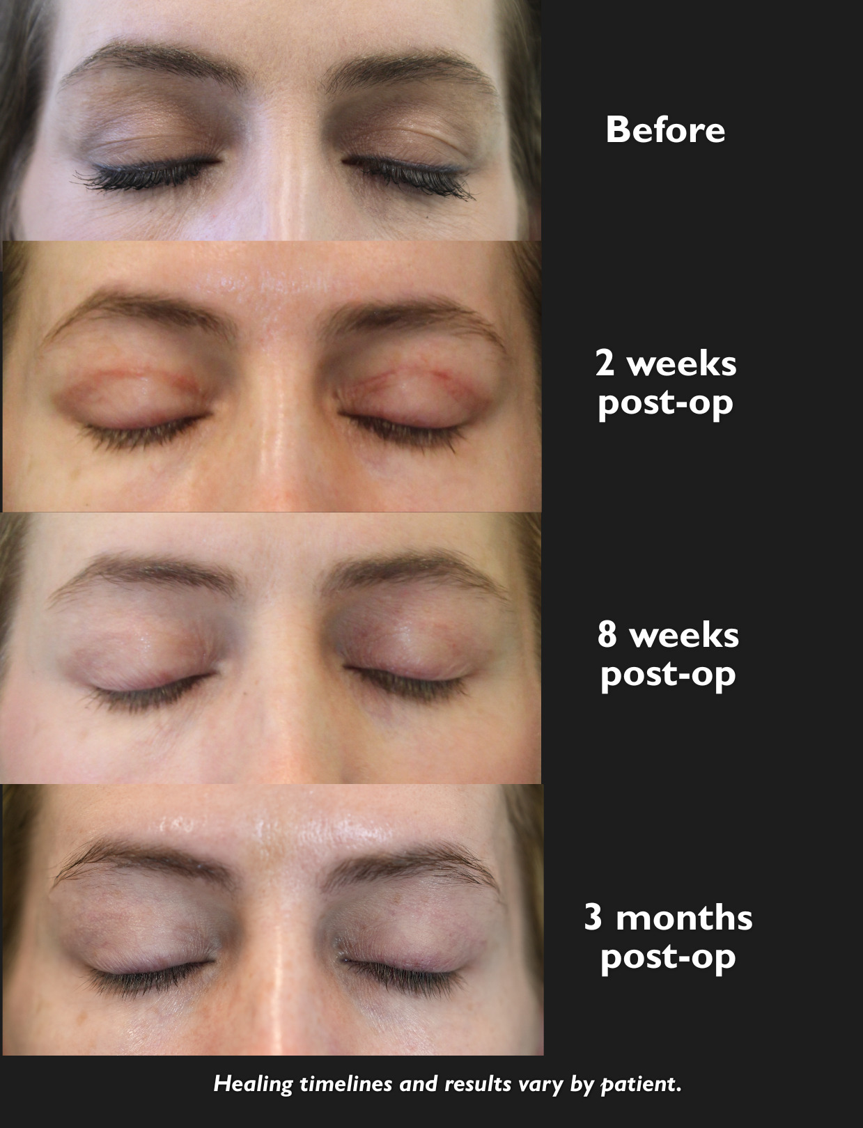 Healing progression showing before surgery, 2 weeks post-op, 8 weeks post-op, and 3 months post-op.