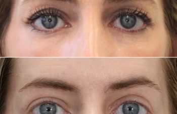 40 year-old before and 3 months after upper eyelid lift, lower blepharoplasty, mini brow lift, and TCA peel, front view