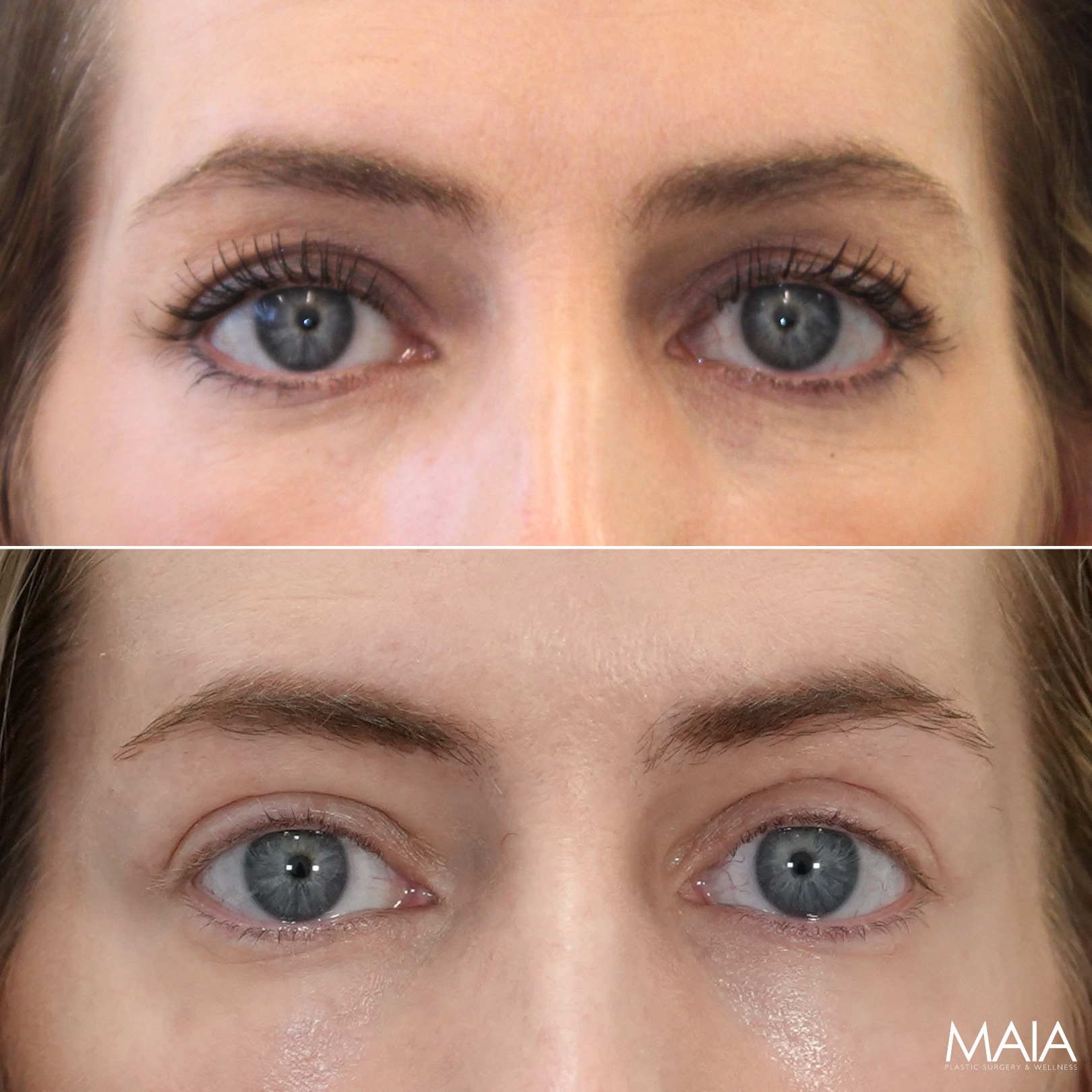 40 year-old before and 3 months after upper eyelid lift, lower blepharoplasty, mini brow lift, and TCA peel, front view