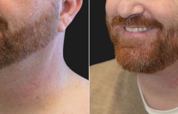 48 year-old male before and 4 months after neck lift and neck liposuction.