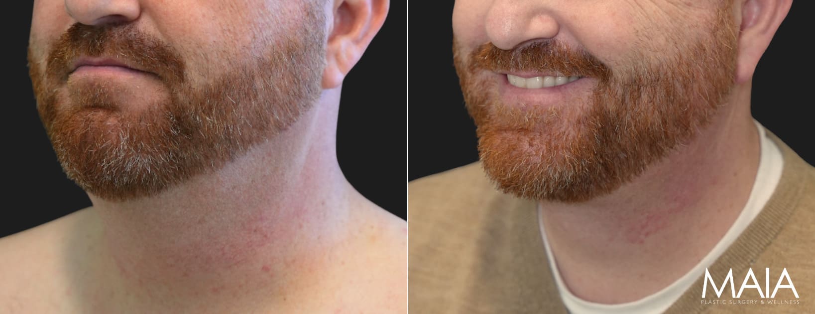 48 year-old male before and 4 months after neck lift and neck liposuction.