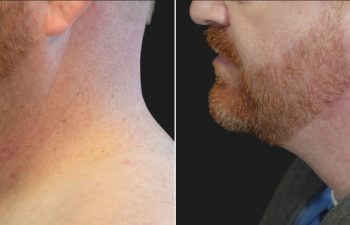 48 year-old male before and 4 months after neck lift and neck liposuction.
