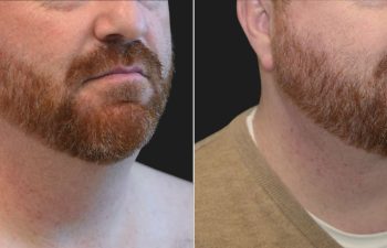 48 year-old male before and 4 months after neck lift and neck liposuction.