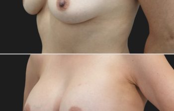 58 year old before and 4 months after Abdominoplasty, Breast Augmentation w Implants, Liposuction of the flanks