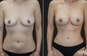 58 year old before and 4 months after Abdominoplasty, Breast Augmentation w Implants, Liposuction of the flanks