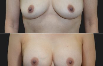 58 year old before and 4 months after Abdominoplasty, Breast Augmentation w Implants, Liposuction of the flanks
