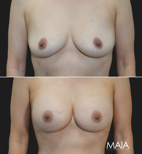 58 year old before and 4 months after Abdominoplasty, Breast Augmentation w Implants, Liposuction of the flanks