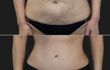 58 year old before and 4 months after Abdominoplasty, Breast Augmentation w Implants, Liposuction of the flanks