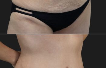 58 year old before and 4 months after Abdominoplasty, Breast Augmentation w Implants, Liposuction of the flanks