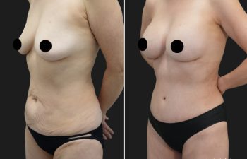 58 year old before and 4 months after Abdominoplasty, Breast Augmentation w Implants, Liposuction of the flanks