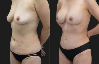 58 year old before and 4 months after Abdominoplasty, Breast Augmentation w Implants, Liposuction of the flanks