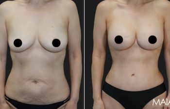 58 year old before and 4 months after Abdominoplasty, Breast Augmentation w Implants, Liposuction of the flanks