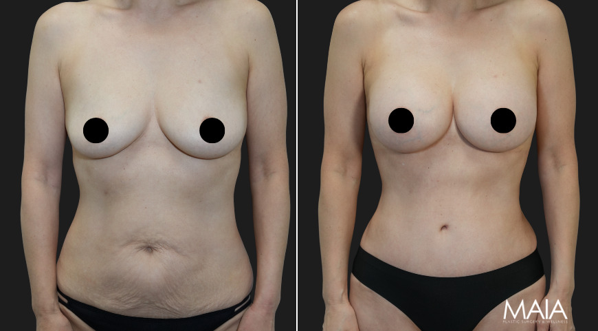 58 year old before and 4 months after Abdominoplasty, Breast Augmentation w Implants, Liposuction of the flanks