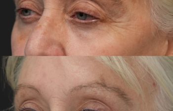 Ky, 70 year-old before and 9 weeks after The Maia Method: Deep Plane Facelift and Neck Lift, Temple Lift, Buccal Fat Pad Removal, Fat Grafting & Nanofat Grafting to the Face, Ear Lobe Reduction (Pixie Ear Correction), Submandibular Gland Removal.