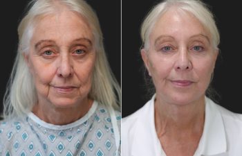 Ky, 70 year-old before and 9 weeks after The Maia Method: Deep Plane Facelift and Neck Lift, Temple Lift, Buccal Fat Pad Removal, Fat Grafting & Nanofat Grafting to the Face, Ear Lobe Reduction (Pixie Ear Correction), Submandibular Gland Removal.