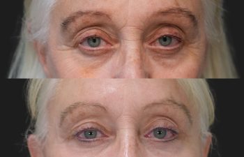 Ky, 70 year-old before and 9 weeks after The Maia Method: Deep Plane Facelift and Neck Lift, Temple Lift, Buccal Fat Pad Removal, Fat Grafting & Nanofat Grafting to the Face, Ear Lobe Reduction (Pixie Ear Correction), Submandibular Gland Removal.