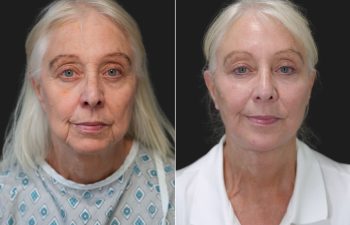 Ky, 70 year-old before and 9 weeks after The Maia Method: Deep Plane Facelift and Neck Lift, Temple Lift, Buccal Fat Pad Removal, Fat Grafting & Nanofat Grafting to the Face, Ear Lobe Reduction (Pixie Ear Correction), Submandibular Gland Removal.