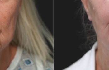 Ky, 70 year-old before and 9 weeks after The Maia Method: Deep Plane Facelift and Neck Lift, Temple Lift, Buccal Fat Pad Removal, Fat Grafting & Nanofat Grafting to the Face, Ear Lobe Reduction (Pixie Ear Correction), Submandibular Gland Removal.