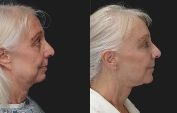 Ky, 70 year-old before and 9 weeks after The Maia Method: Deep Plane Facelift and Neck Lift, Temple Lift, Buccal Fat Pad Removal, Fat Grafting & Nanofat Grafting to the Face, Ear Lobe Reduction (Pixie Ear Correction), Submandibular Gland Removal.