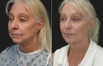Ky, 70 year-old before and 9 weeks after The Maia Method: Deep Plane Facelift and Neck Lift, Temple Lift, Buccal Fat Pad Removal, Fat Grafting & Nanofat Grafting to the Face, Ear Lobe Reduction (Pixie Ear Correction), Submandibular Gland Removal.