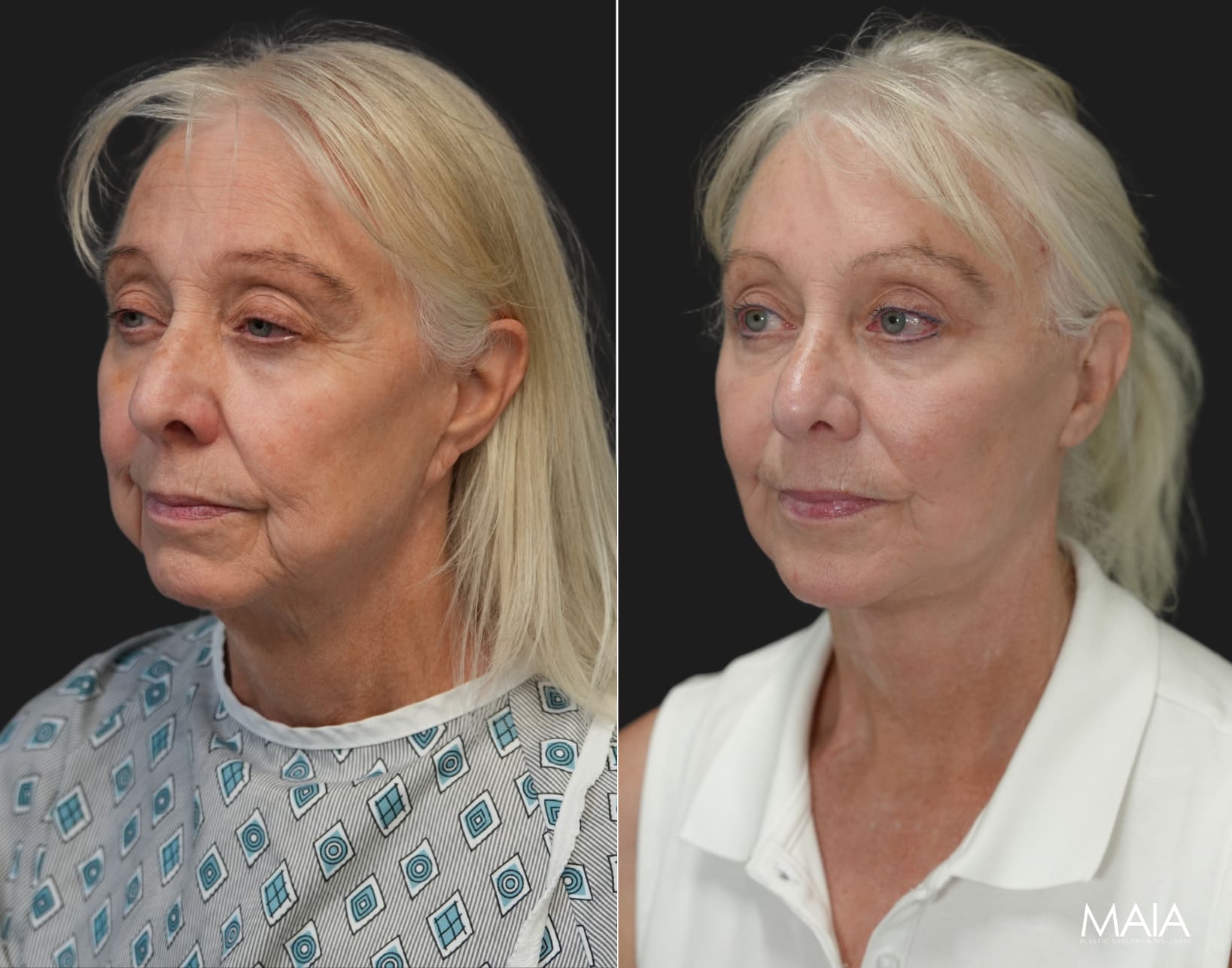 Ky, 70 year-old before and 9 weeks after The Maia Method: Deep Plane Facelift and Neck Lift, Temple Lift, Buccal Fat Pad Removal, Fat Grafting & Nanofat Grafting to the Face, Ear Lobe Reduction (Pixie Ear Correction), Submandibular Gland Removal.