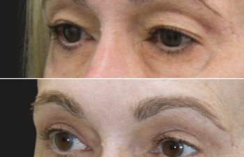 55 year-old patient before and 4 months after upper blepharoplasty