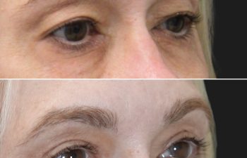 55 year-old patient before and 4 months after upper blepharoplasty