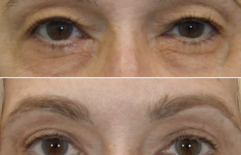 55 year-old patient before and 4 months after upper blepharoplasty