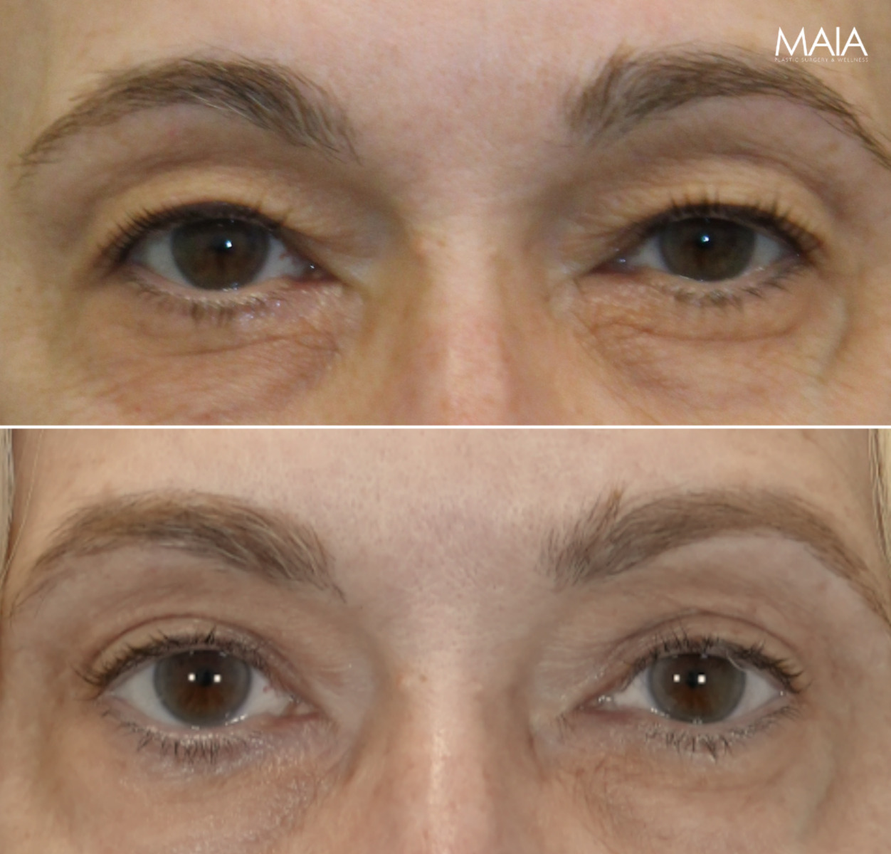 55 year-old patient before and 4 months after upper blepharoplasty