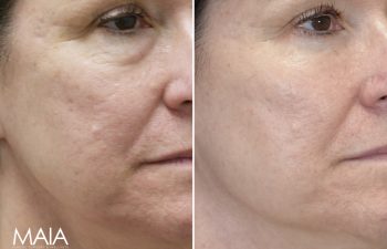 62 year-old before and 7 weeks after Lower Blepharoplasty, Fat grafting and Nanofat Grafting to Undereyes and Upper Cheeks