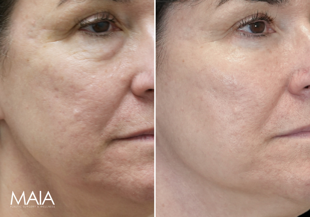 62 year-old before and 7 weeks after Lower Blepharoplasty, Fat grafting and Nanofat Grafting to Undereyes and Upper Cheeks