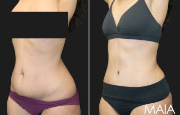 36 year old before and 1 month after Abdominoplasty