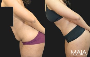 36 year old before and 1 month after Abdominoplasty