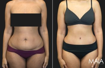 36 year old before and 1 month after Abdominoplasty
