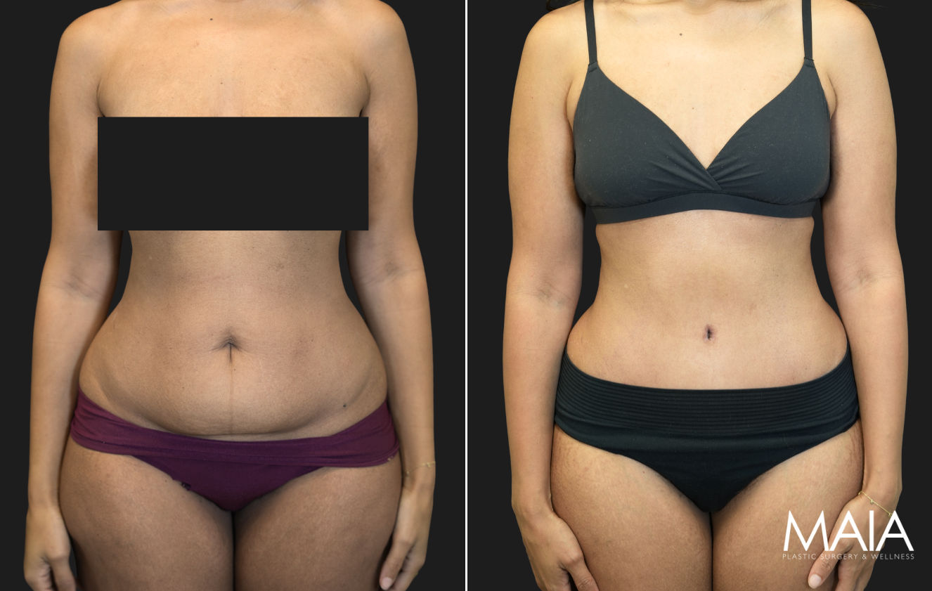 36 year old before and 1 month after Abdominoplasty